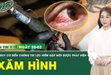 Bản tin Y tế 20/2: Hàng chục người mắc biến chứng thị lực hiếm gặp sau xăm hình