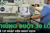 Sốt kéo dài hai tuần, bé trai nhiễm vi khuẩn hiếm khiến ruột thủng hơn 30 lỗ