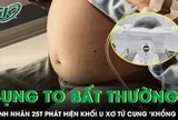 Bóc tách thành công khối u xơ tử cung “khổng lồ” cho nữ bệnh nhân 25 tuổi