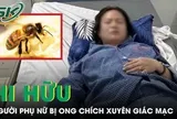 Ong chích xuyên giác mạc, người phụ nữ sưng phù mắt phải cấp cứu khẩn