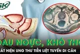 Phát hiện ung thư tiền liệt tuyến di căn từ triệu chứng đau ngực khó thở