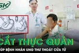 Người đàn ông phải cắt thực quản để điều trị ung thư