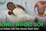 Bé 22 tháng tuổi bỏng nước sôi cấp cứu trong nguy kịch
