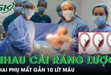 Thai phụ 36 tuần mất gần 10 lít máu, nguy hiểm tính mạng vì tai biến nhau cài răng lược