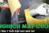 Bé 7 tuổi ở Lào Cai bị máy cuốn dập nát bàn tay do nghịch máy bào quế tự chế