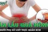 Người phụ nữ loét thực quản 8cm vì thói quen ăn lẩu quá nóng