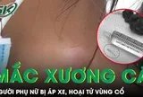Xương cá nằm trong họng 5 tháng gây áp xe hoại tử vùng cổ