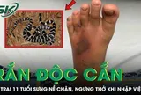 Bé trai 11 tuổi bị rắn độc cắn, sưng nề chân, ngưng thở khi nhập viện