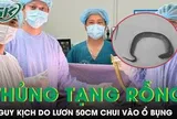 Người đàn ông thủng tạng rỗng do con lươn dài 50cm chui vào ổ bụng
