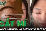 Tin lời 'chuyên gia' thẩm mỹ, người phụ nữ nhận kết cục đau đớn sau cắt mí mắt
