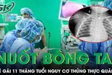Nuốt phải bông tai kim loại, bé gái 11 tháng tuổi đối mặt nguy cơ thủng thực quản