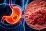 Bác sĩ cảnh báo: 1 THÓI QUEN trước khi ngủ đang âm thầm làm tăng nguy cơ ung thư dạ dày, nhiều người Việt vẫn làm hàng ngày