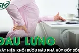 Đau lưng kéo dài, người phụ nữ phát hiện khối bướu máu đã phá hủy gần toàn bộ đốt sống