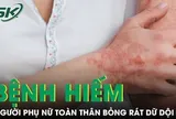 Căn bệnh hiếm khiến người phụ nữ sốt cao, toàn thân đỏ rực và bỏng rát dữ dội