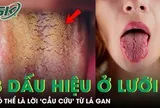 Đừng bỏ qua 3 dấu hiệu bất thường này trên lưỡi, có thể là lời 'cầu cứu' từ lá gan