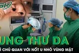 Chủ quan với nốt u nhỏ, người bệnh phát hiện ung thư da vùng mặt