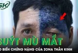 Người đàn ông 54 tuổi suýt mù mắt do biến chứng nặng của zona thần kinh