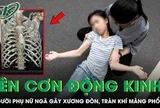 Người phụ nữ ngã gãy xương đòn, tràn máu màng phổi vì lên cơn động kinh