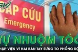Tự nhuộm tóc tại nhà người đàn ông nhập viện vì hai bàn tay sưng to phồng rộp