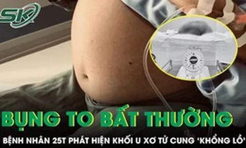 Bóc tách thành công khối u xơ tử cung “khổng lồ” cho nữ bệnh nhân 25 tuổi