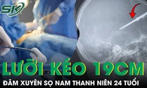 Cứu nam thanh niên 24 tuổi bị lưỡi kéo dài 19 cm đâm xuyên sọ não