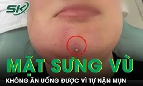 Nặn mụn cằm, người phụ nữ nhập viện vì mặt sưng vù, không ăn uống được