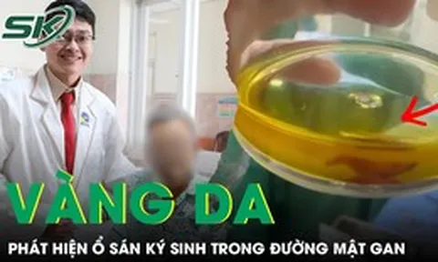 Vàng da, tắc mật do sán ký sinh trong đường mật gan