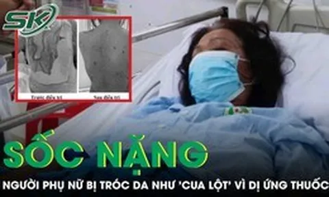 Tự ý dùng thuốc, người phụ nữ sốc nặng khi da bị tróc như 'cua lột'