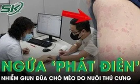 Ngứa ‘phát điên’, người đàn ông đi khám phát hiện nhiễm giun đũa chó mèo