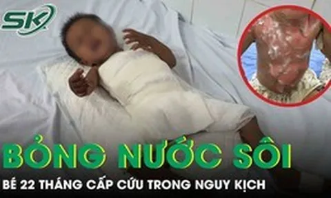 Bé 22 tháng tuổi bỏng nước sôi cấp cứu trong nguy kịch
