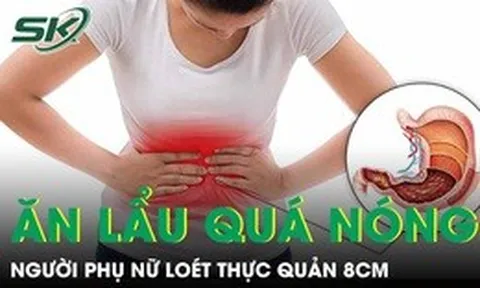 Người phụ nữ loét thực quản 8cm vì thói quen ăn lẩu quá nóng