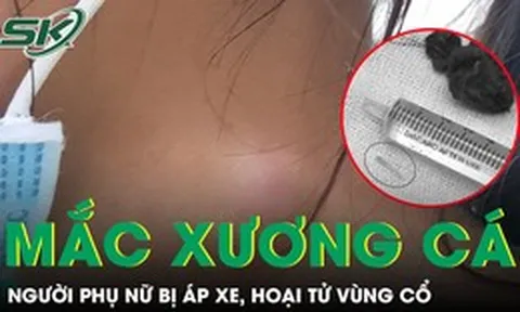 Xương cá nằm trong họng 5 tháng gây áp xe hoại tử vùng cổ