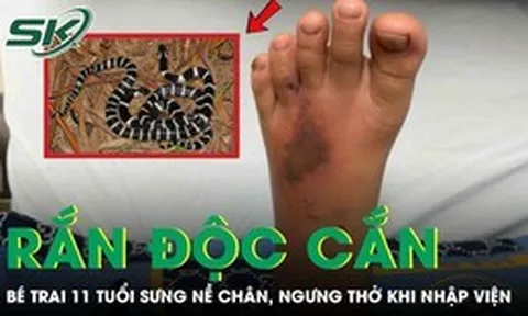 Bé trai 11 tuổi bị rắn độc cắn, sưng nề chân, ngưng thở khi nhập viện