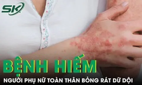 Căn bệnh hiếm khiến người phụ nữ sốt cao, toàn thân đỏ rực và bỏng rát dữ dội
