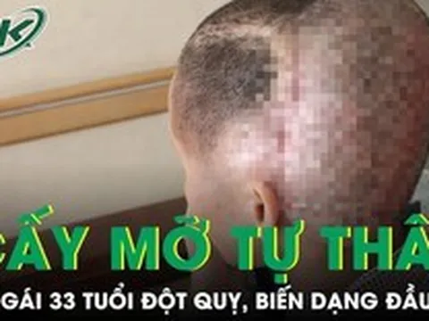 Cấy mỡ tự thân, cô gái 33 tuổi đột quỵ, biến dạng đầu