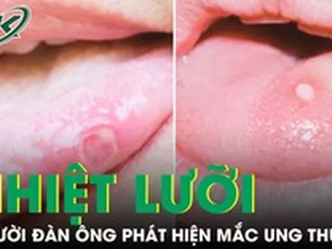Người đàn ông phát hiện mắc ung thư từ dấu hiệu lạ ở lưỡi