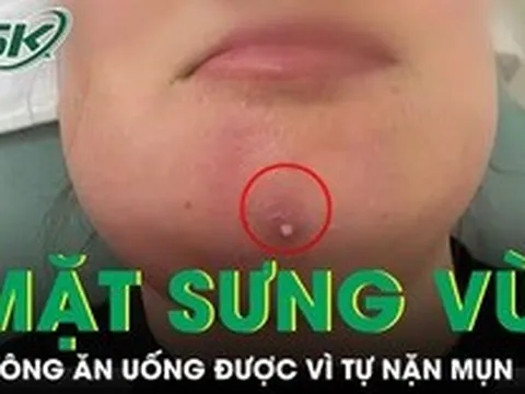 Nặn mụn cằm, người phụ nữ nhập viện vì mặt sưng vù, không ăn uống được
