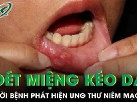 Loét miệng kéo dài, người bệnh phát hiện ung thư niêm mạc má
