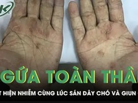 Ngứa toàn thân suốt 2 tháng, người đàn ông phát hiện nhiễm cùng lúc sán dây chó và giun đũa