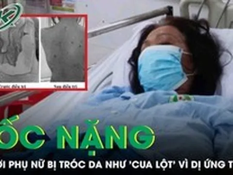 Tự ý dùng thuốc, người phụ nữ sốc nặng khi da bị tróc như 'cua lột'