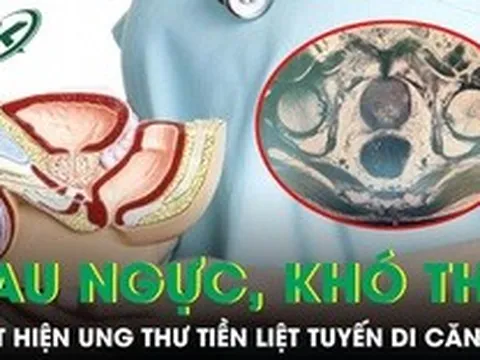 Phát hiện ung thư tiền liệt tuyến di căn từ triệu chứng đau ngực khó thở