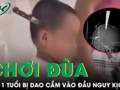 Hai anh em chơi đùa tại nhà, bé 11 tuổi bị dao cắm vào đầu nguy kịch