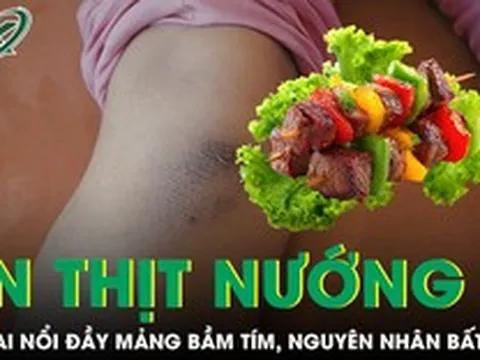 Bé trai nổi đầy mảng bầm tím sau bữa ăn thịt nướng, bác sĩ phát hiện nguyên nhân bất ngờ