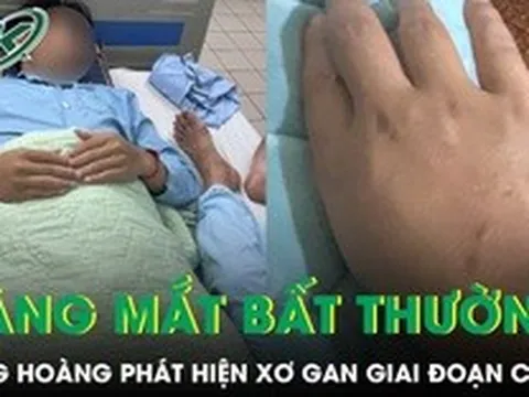 Da và mắt vàng bất thường, chàng trai 21 tuổi bàng hoàng phát hiện xơ gan giai đoạn cuối