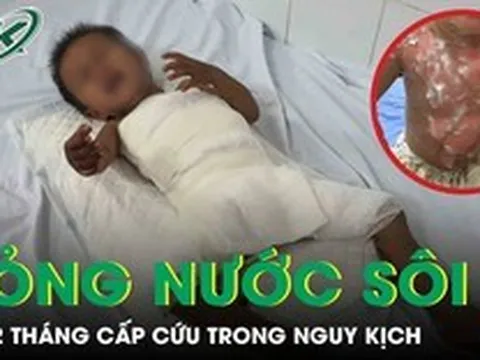 Bé 22 tháng tuổi bỏng nước sôi cấp cứu trong nguy kịch