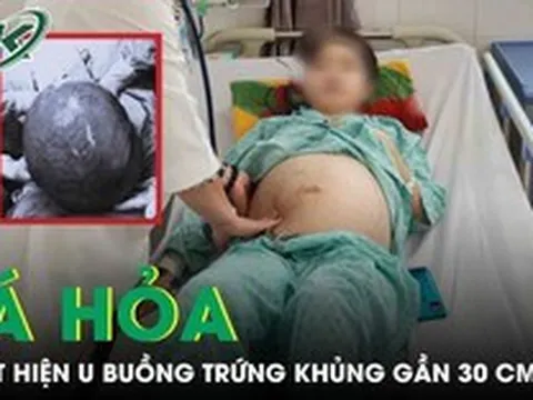 Tá hoả phát hiện khối u buồng trứng ‘cực khủng’ gần 30cm từ dấu hiệu đau bụng