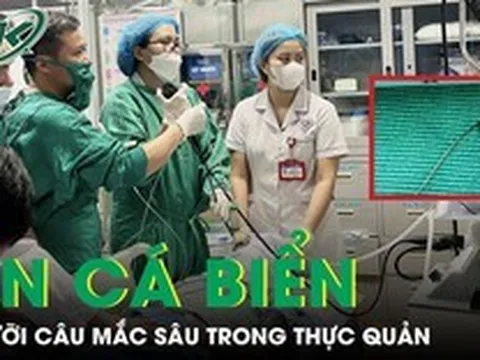 Hiếm gặp: Ăn cá biển, người đàn ông bị lưỡi câu mắc sâu trong thực quản