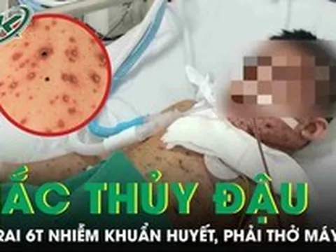 Biến chứng thủy đậu, bé trai 6 tuổi nhiễm khuẩn huyết, phải thở máy nguy kịch