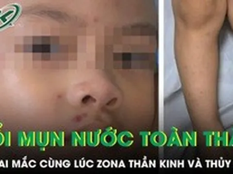 Bé trai 4 tuổi nổi kín mụn nước toàn thân sau khi mắc cùng lúc zona thần kinh và thủy đậu
