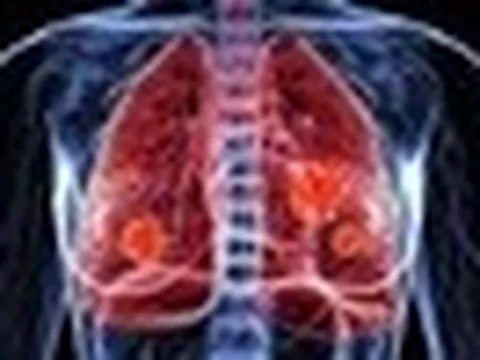 Con số đáng lo ngại về ung thư phổi tại Việt Nam